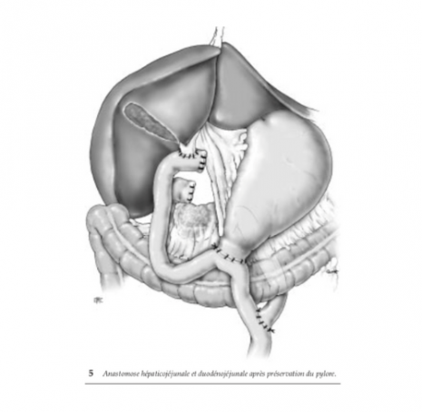 Double dérivation bilio-digestive