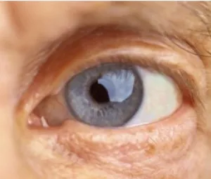 Chirurgie ophtalmologique