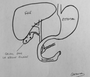 Calcul voie biliaire