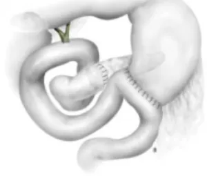 Duodéno-pancréatectomie céphalique