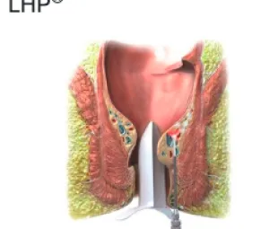 Traitement LHP - Hemorroides chirurgie AÉSIO Santé