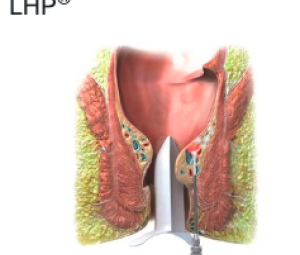 Traitement LHP - Hemorroides chirurgie AÉSIO Santé