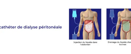 LE CATHETER DE DIALYSE PERITONEALE.
