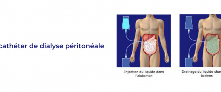 LE CATHETER DE DIALYSE PERITONEALE.