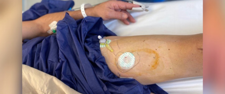Prothèse de genou : des cathéters à domicile pour une continuité des soins
