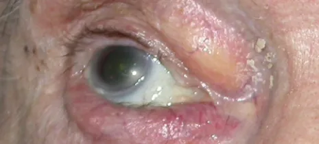 pathologiespalpebrales