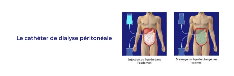 LE CATHETER DE DIALYSE PERITONEALE.