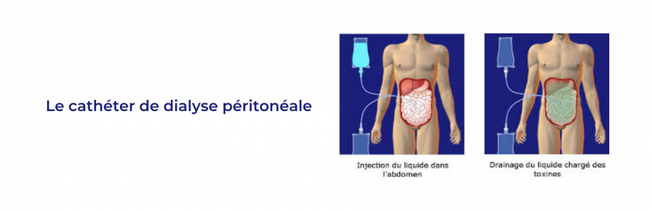 LE CATHETER DE DIALYSE PERITONEALE.