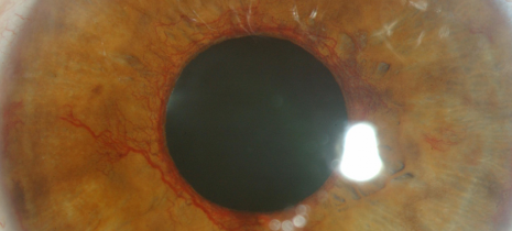 retinopathiediabvisuel